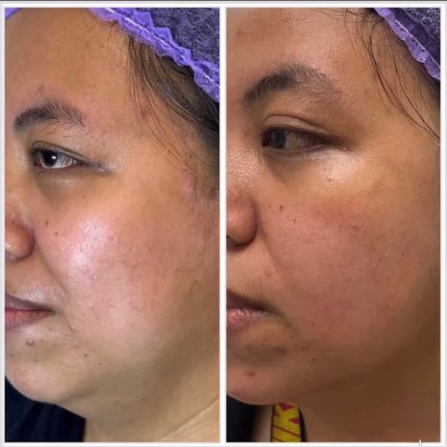 Face Lift and Contour - 6 sessions at Derma Aesthetics by Juvy in Brea, CA