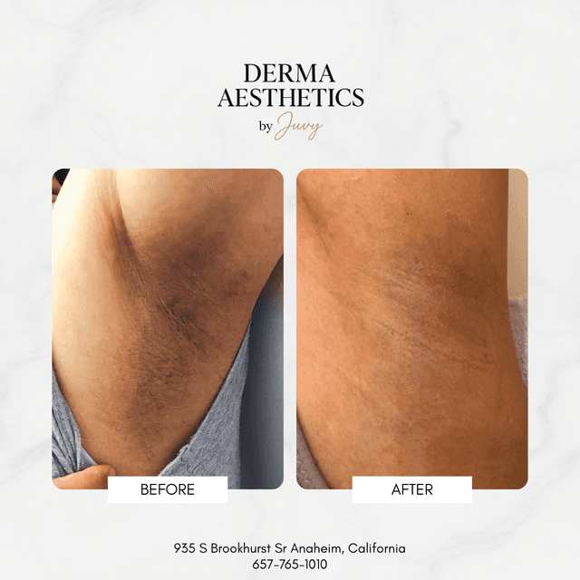 3 Sessions Underarm Treatment at Derma Aesthetics by Juvy in Brea, CA